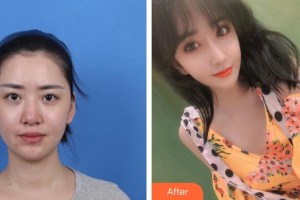 第四军医大学唐都医院整形激光美容中心李跃军整形价格表附鼻部综合案例展示