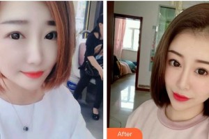 第四军医大学唐都医院整形激光美容中心李学拥整形价格表附肋软骨隆鼻案例展示