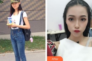 第四军医大学唐都医院整形激光美容中心李金清整形价格表附假体隆鼻案例展示