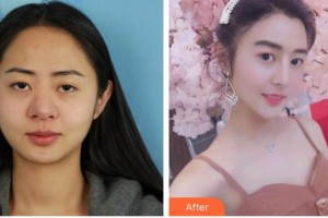 第四军医大学唐都医院整形激光美容中心杜洁整形价格表附鼻部综合案例展示