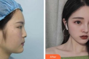 第四军医大学唐都医院整形激光美容中心李靖整形价格表附鼻部综合案例展示