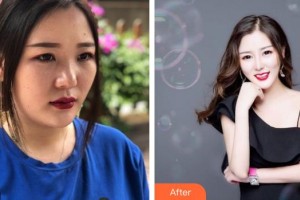 第四军医大学唐都医院整形激光美容中心曹彦整形价格表附耳软骨复合隆鼻案例展示