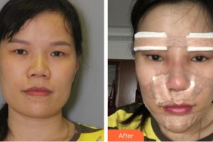 第四军医大学唐都医院整形激光美容中心刘纲整形价格表附鼻部综合案例展示