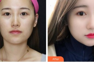 中国医学科学院整形外科医院庄洪兴整形价格表附去痘印痘坑案例展示