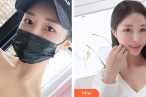 中国医学科学院整形外科医院张智勇整形价格表附清洁祛痘案例展示