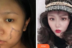 中国医学科学院整形外科医院滕利整形价格表附激光祛疤案例展示