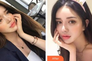 中国医学科学院整形外科医院范飞整形价格表附镭射净肤案例展示