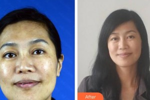 中国医学科学院整形外科医院罗家麟副教授整形价格表附微针美肤案例展示