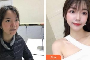 中国医学科学院整形外科医院吕长胜整形价格表附清洁祛痘案例展示