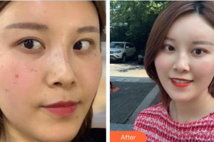 中国医学科学院整形外科医院孙晓梅整形价格表附彩光嫩肤案例展示