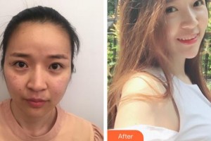 中国医学科学院整形外科医院赵延勇整形价格表附去痘印痘坑案例展示