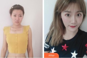 中国医学科学院整形外科医院宋维铭整形价格表附激光祛疤案例展示