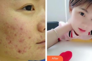 中国医学科学院整形外科医院刘立强、副教授整形价格表附去痘印痘坑案例展示