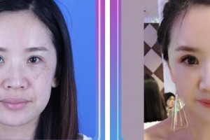 中国医学科学院整形外科医院穆大力整形价格表附激光祛斑案例展示