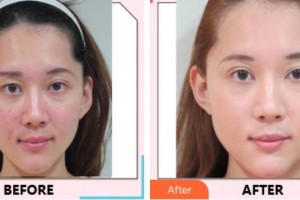 中国医科大学航空总医院皮肤激光整形美容中心孙志成整形价格表附镭射净肤案例展示