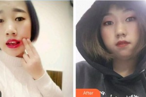 中国航天科工集团731医院整形美容科陈志刚整形价格表附根管调节案例展示