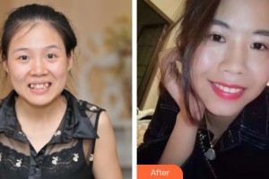 中国医科大学航空总医院拇外翻矫正科宋春兰整形价格表附自锁托槽矫正案例展示