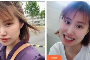 中国医科大学航空总医院皮肤激光整形美容中心于红敏整形价格表附金属托槽矫正案例展示