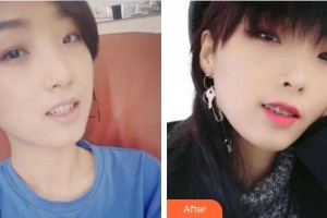 中国医科大学航空总医院疤痕修复科陈业忠整形价格表附金属托槽矫正案例展示