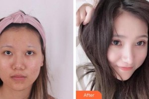 中国科大眼科医院刘才远整形价格表附切开双眼皮案例展示