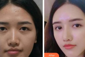 中国科大眼科医院陈莺整形价格表附开内眼角案例展示