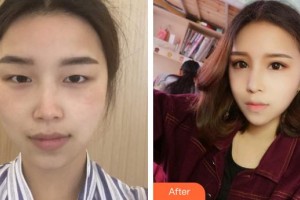 中国医科大学附属第一医院整形外科徐楠整形价格表附眼部综合案例展示