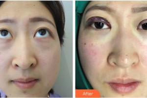 中国医科大学附属第一医院整形外科冷冰整形价格表附眼部综合案例展示