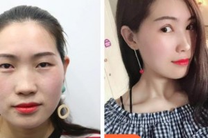 中国医科大学附属第一医院整形外科佟爽整形价格表附切开双眼皮案例展示