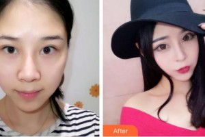 中国医科大学附属第一医院整形外科郭家妍整形价格表附眼部综合案例展示