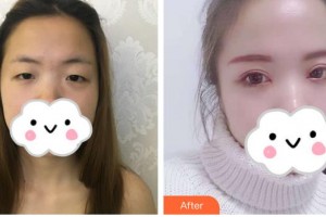 中国医科大学附属第一医院整形外科唐明睿整形价格表附眼部综合案例展示