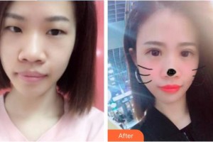 中国医科大学附属第一医院整形外科王玉新整形价格表附切开双眼皮案例展示