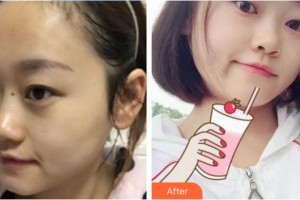 福清天宝美容医院孟祥重整形价格表附膨体隆鼻案例展示