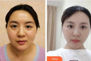 福清天宝美容医院熊世文整形价格表附膨体隆鼻案例展示