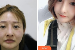 福清天宝美容医院林芳整形价格表附鼻部综合案例展示