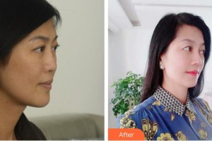 福清天宝美容医院叶存祥整形价格表附鼻部综合案例展示