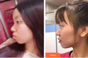 福清天宝美容医院舒小芳整形价格表附金属托槽矫正案例展示