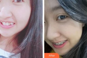 象山华美整形美容医院洪燕整形价格表附金属托槽矫正案例展示