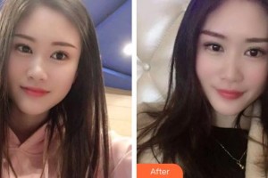 象山华美整形美容医院许哲整形价格表附冷光美白案例展示