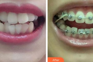 象山华美整形美容医院沉载善整形价格表附金属托槽矫正案例展示