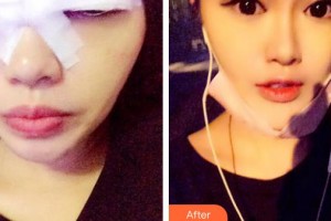 象山爱尔眼科医院赵景峰整形价格表附切开双眼皮案例展示