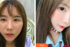 象山爱尔眼科医院张美萍整形价格表附下睑整形案例展示