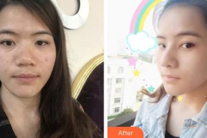 郴州维纳斯医疗美容医院汪海滨整形价格表附耳软骨复合隆鼻案例展示