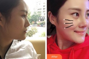郴州韩雅医疗美容医院刘萍高整形价格表附鼻部综合案例展示