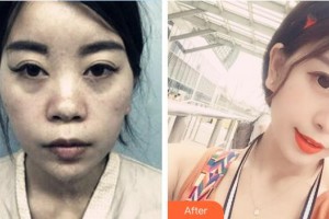 郴州市第一人民医院整形美容科唐红伟整形价格表附鼻部综合案例展示