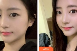 郴州韩雅医疗美容医院明经发整形价格表附鼻部综合案例展示