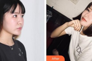 郴州市第一人民医院整形美容科程勇整形价格表附垫鼻基底案例展示