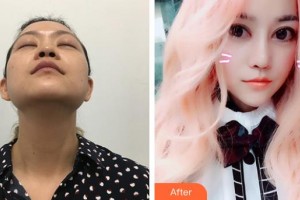 郴州韩雅医疗美容医院杨娇整形价格表附鼻部综合案例展示