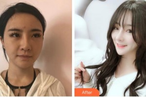 郴州市第一人民医院整形美容科梁志为整形价格表附鼻部综合案例展示