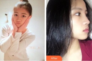 郴州市明华医院医学美容科窦学礼 整形价格表附鼻部综合案例展示