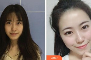 郴州唯美医疗整形医院许艳芳整形价格表附无针水光案例展示